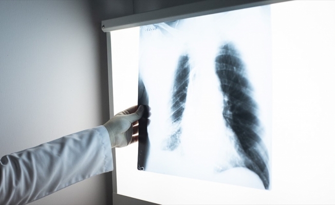 Göğüs röntgeninden hastalık teşhisi yapay zekayla hızlanacak