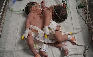 Ameliyatla ayrılan Suriyeli siyam ikizlerinden biri öldü