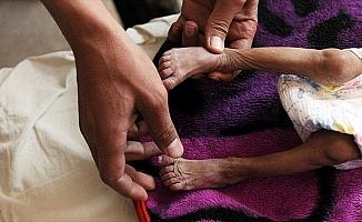 İHH İnsani Yardım Vakfı Genel Başkanı Yıldırım: Yemen'de çocuklar bir deri bir kemik kalmış durumda